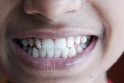 Burnos irigatorius ar elektrinis dantų šepetukas: skirtumas ir pasirinkimas /