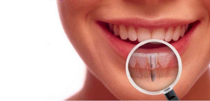 Dantų implantavimas – vis labiau populiarėjantis pasirinkimas /