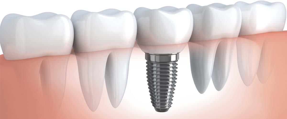 Kaip pasirinkti dantų implantus? /