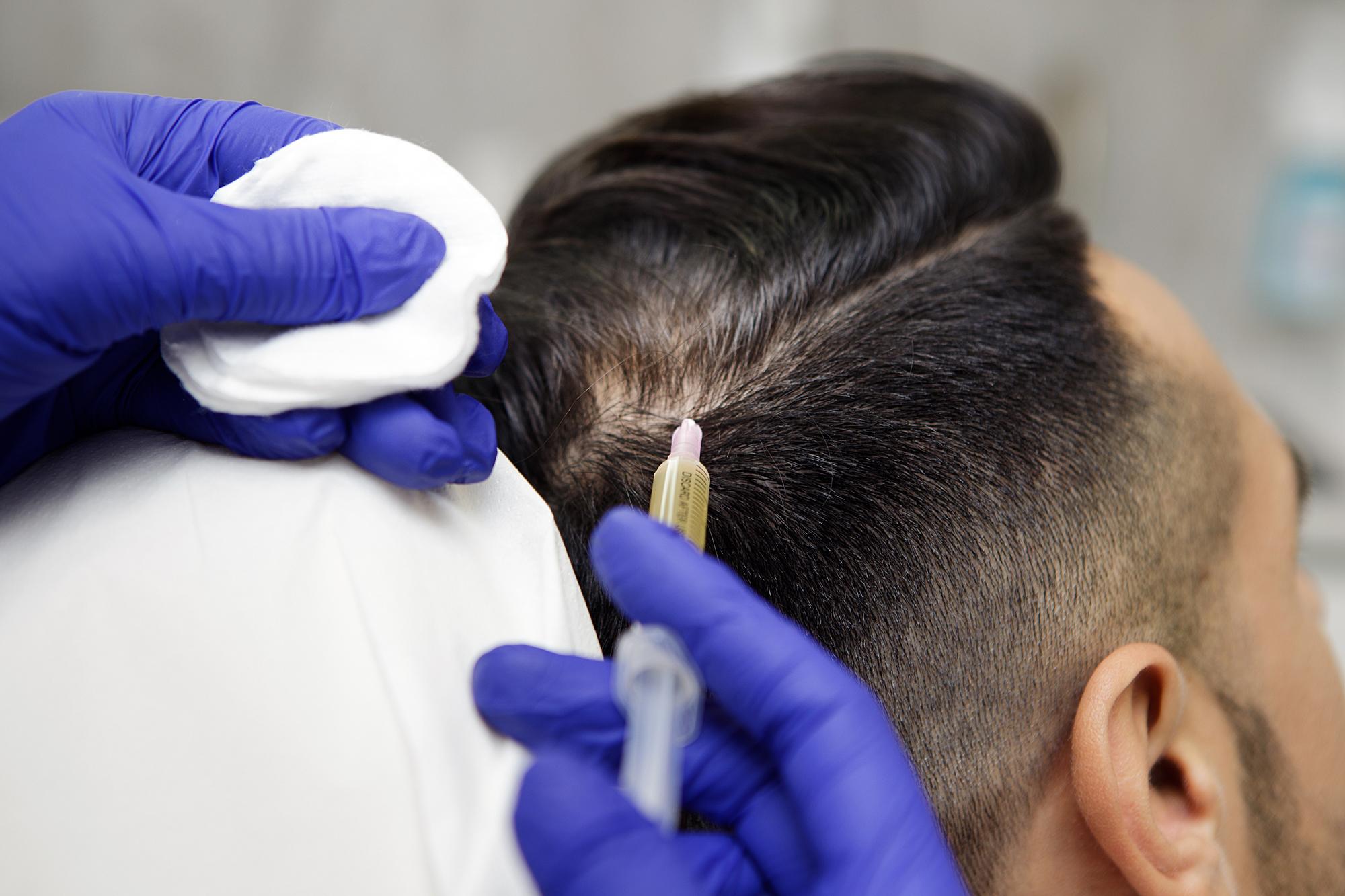 Mezoterapija plaukams: ir sveikatai gerinti