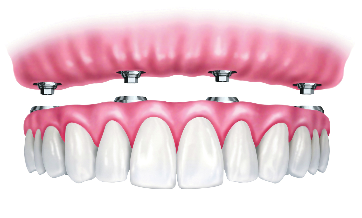 su dantų implantais dirbanti jau beveik dešimtmetį ir šypsenas sugrąžinusi šimtams pacientų.