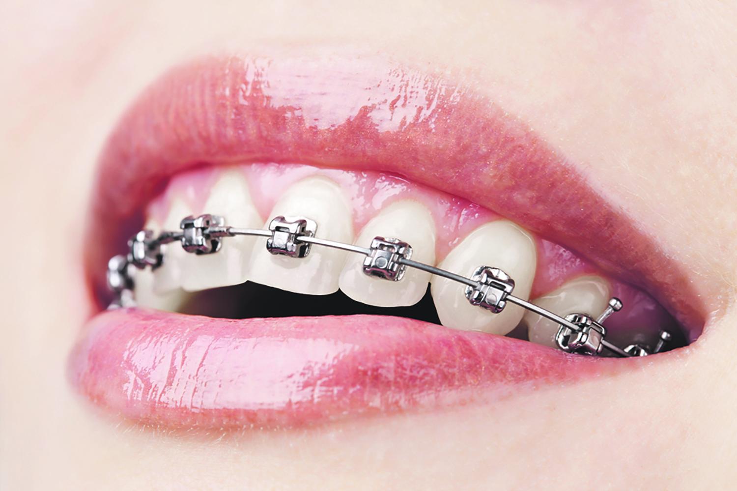Sveiki dantys ir graži šypsena puošia kiekvieną / Odontologijos klinikoje „Estetinė odontologija“ pacientams dantys tiesinami ir breketais.